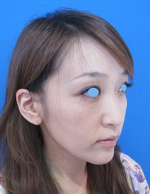 目の下のたるみ、目のくまでお悩みの方、切らずに完璧に解決します。TCB-R法　手術直後　症例写真